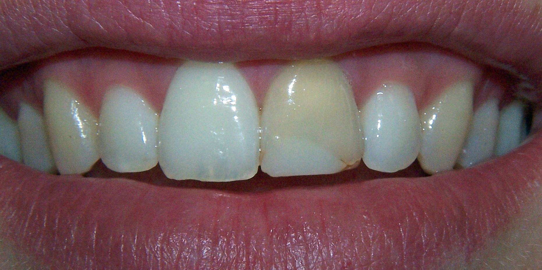 Before